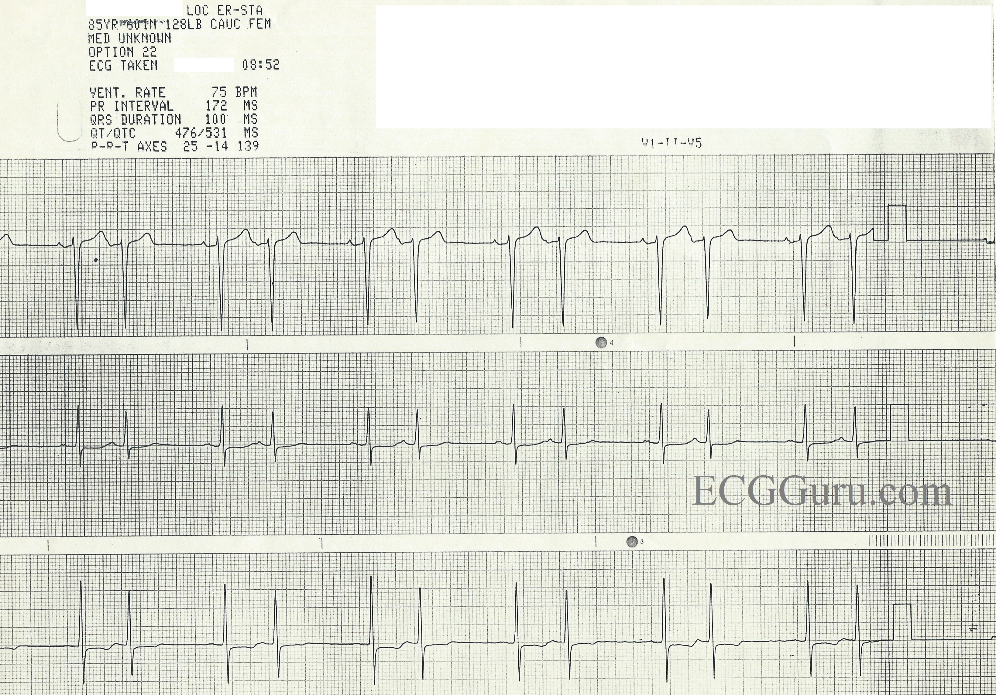 Atrial Bigeminy Ecg Guru Instructor Resources 